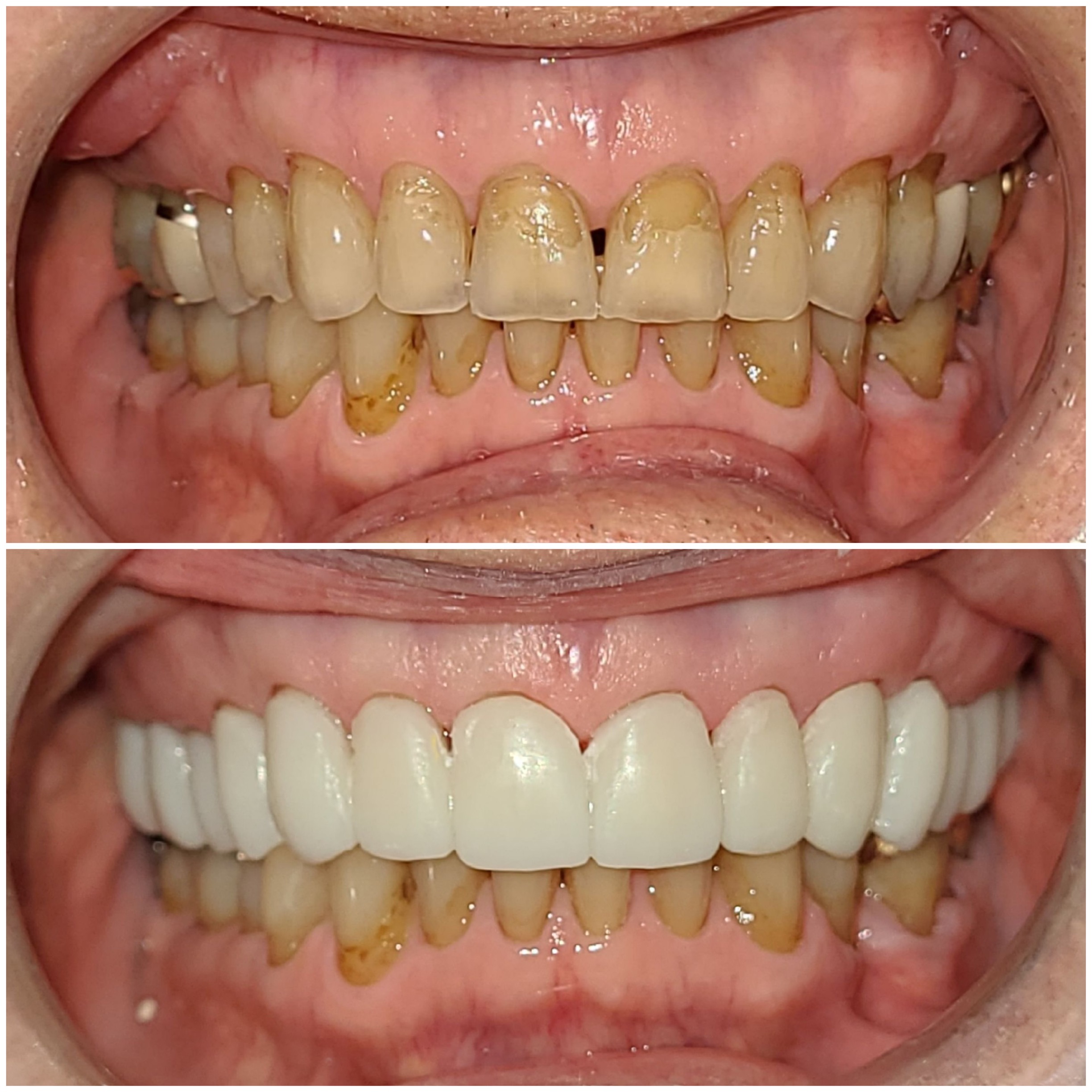 Dental Crown Dubai
